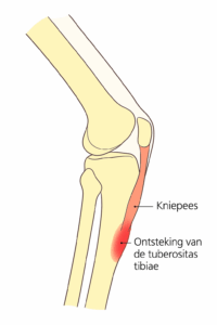 Osgood-Schlatter